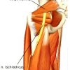 Wat is het piriformis syndroom? piriformis